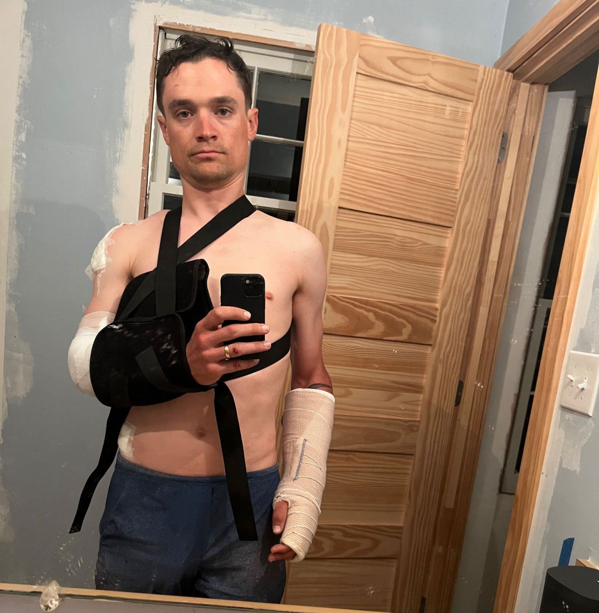 Robin Carpenter shows his injuries after the Spartanburg Criterium crash